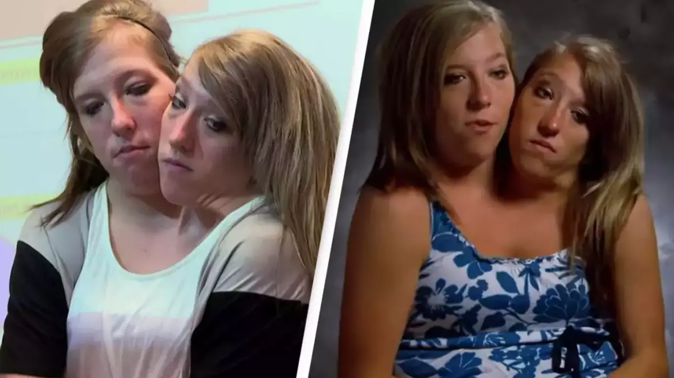 Abby und Brittany Hensel verstorben